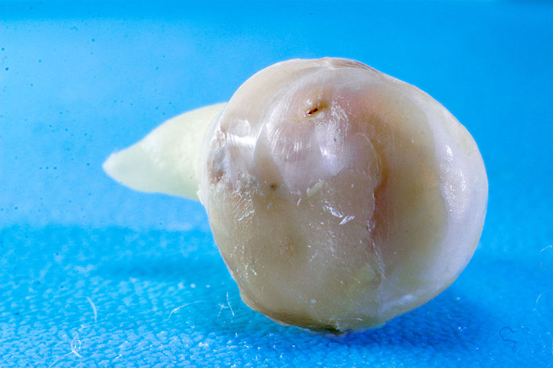 My removed wisdom tooth