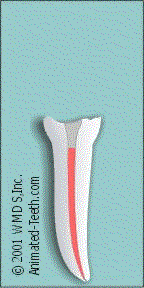Amusing animated image of root canal treatment