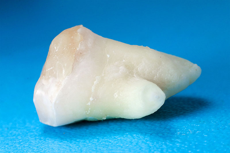 My removed wisdom tooth