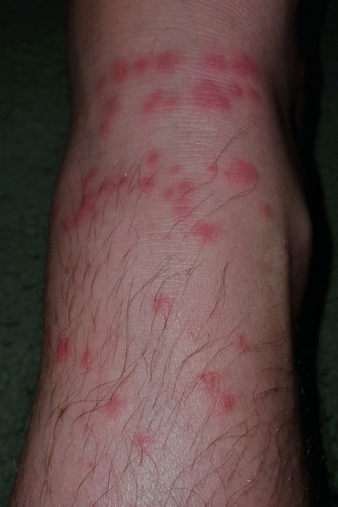 Jellyfish stings on Ned’s leg