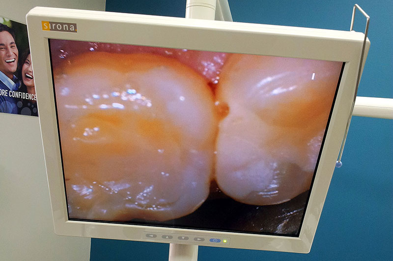  Teeth prior to filling removal. Note small hole.