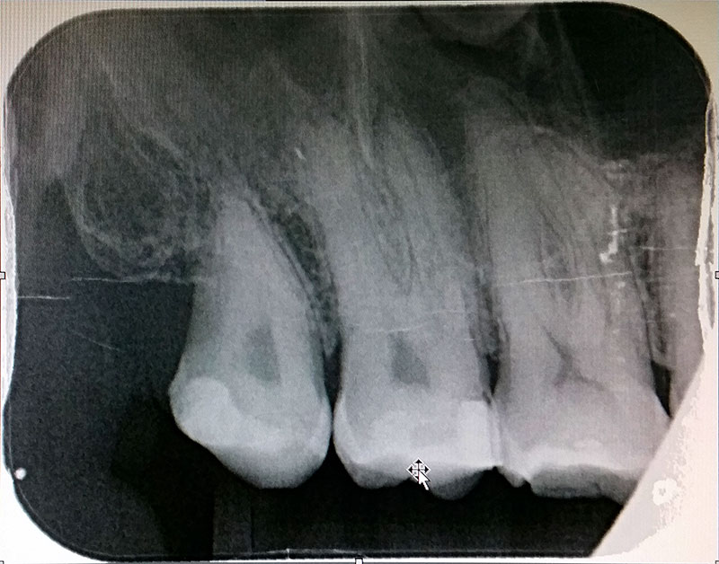 X-Ray of my tooth
