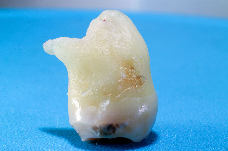 My removed wisdom tooth