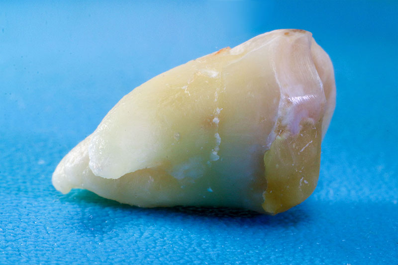 My removed wisdom tooth