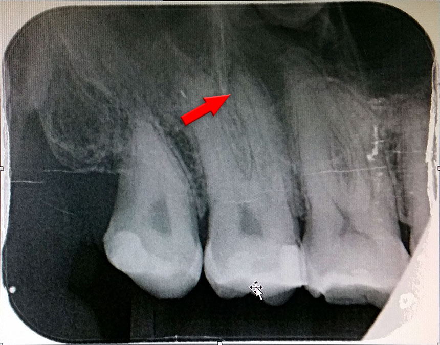 X-Ray of my tooth. The marked circle is apparently infection