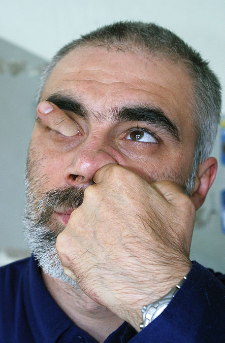 Man with finger up nose and out of eye